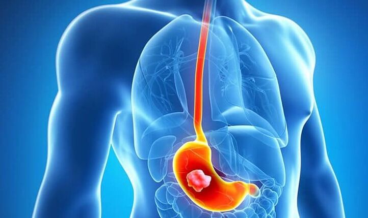 Se hai un'ulcera allo stomaco, aderire alla dieta Dukan è controindicato.