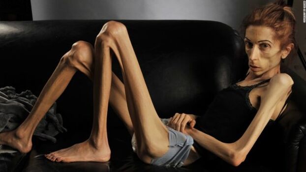 anoressia